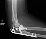 Right radial head prosthesis lateral view